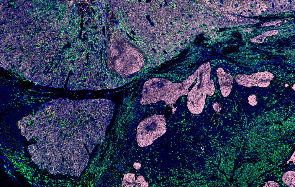 MasSpec Pen: False-color image of cancer cells.