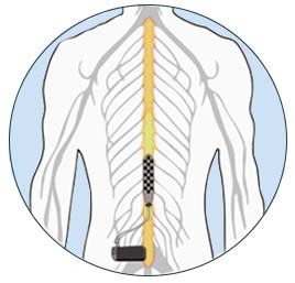 Epidural Stimulator Illustration