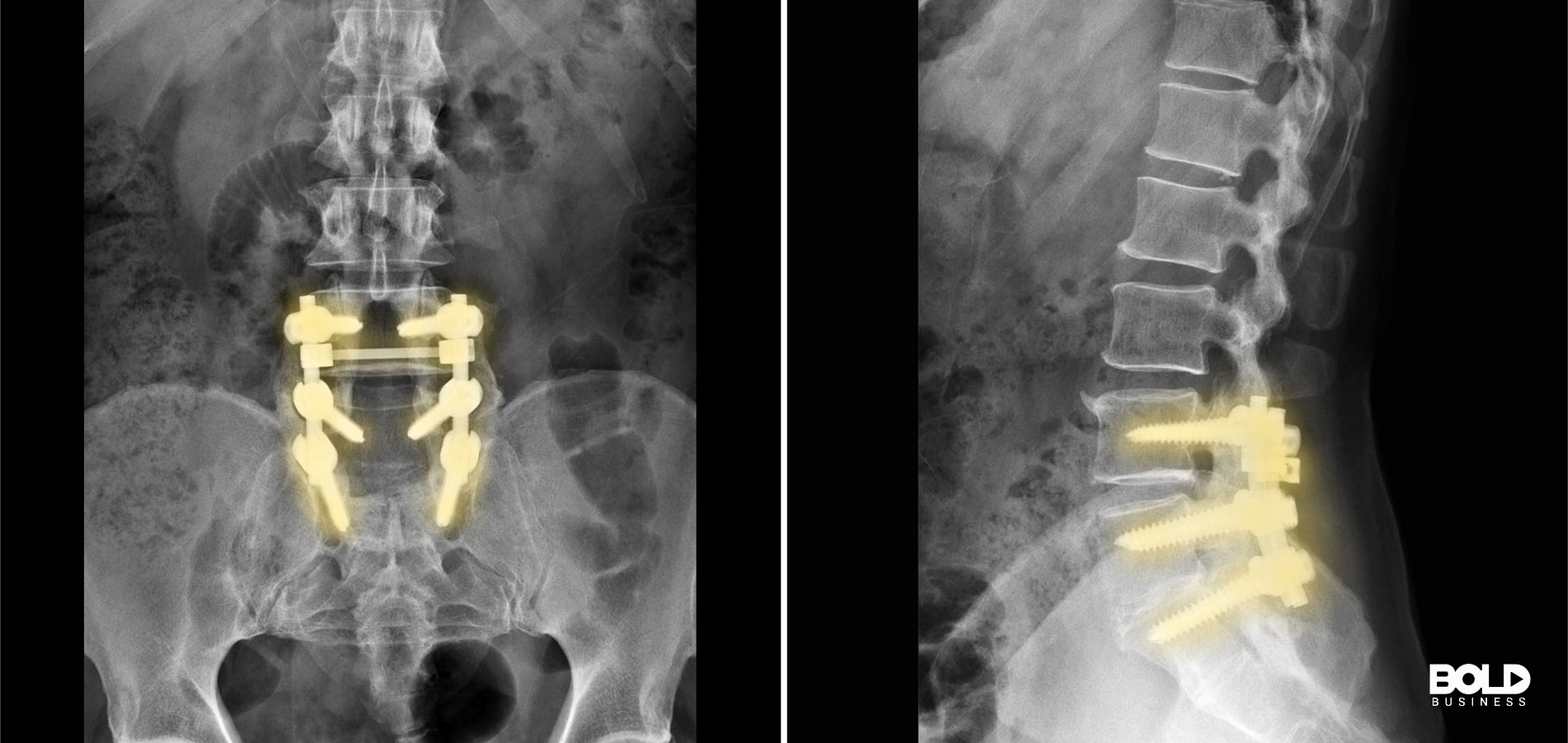 Some x-rays of spinal cord implants