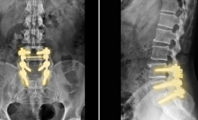 Some x-rays of spinal cord implants