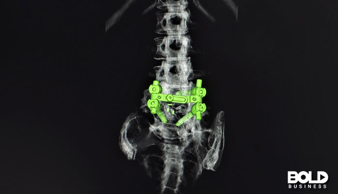 An x-ray of a spine with implants